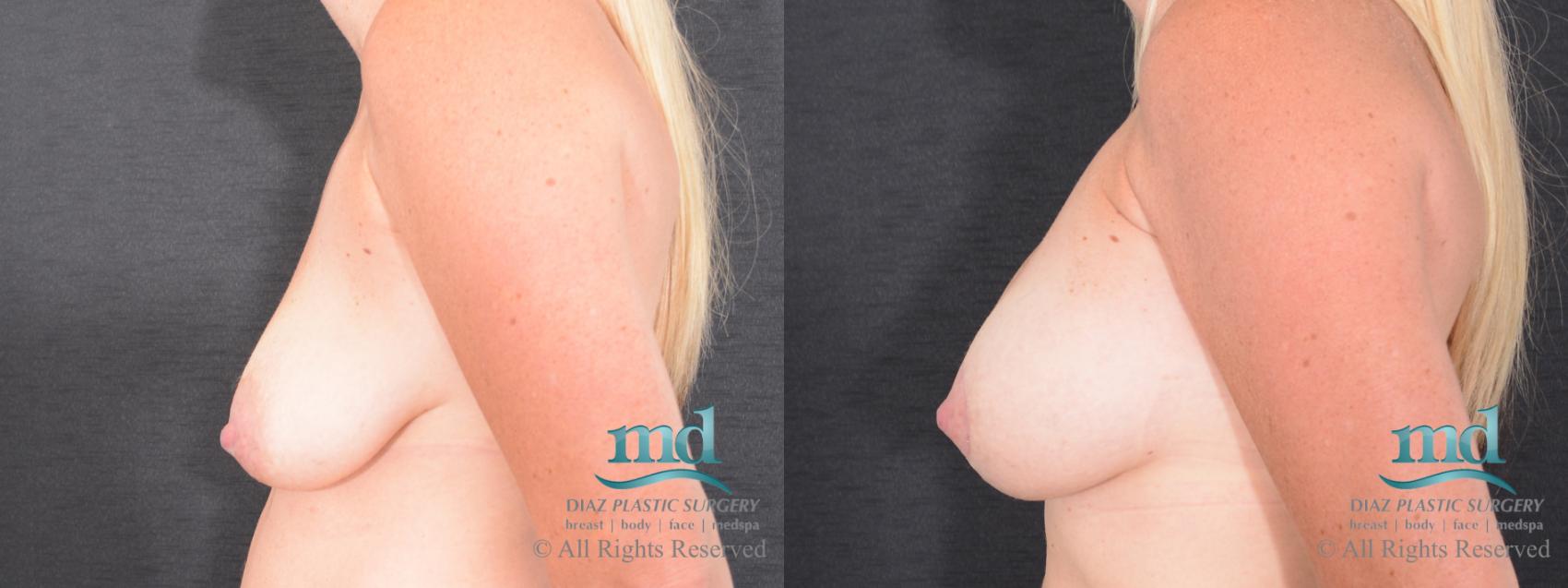 Before & After Breast Lift Case 127 View #5 View in Melbourne, FL