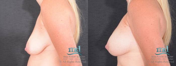 Before & After Breast Lift Case 127 View #5 View in Melbourne, FL