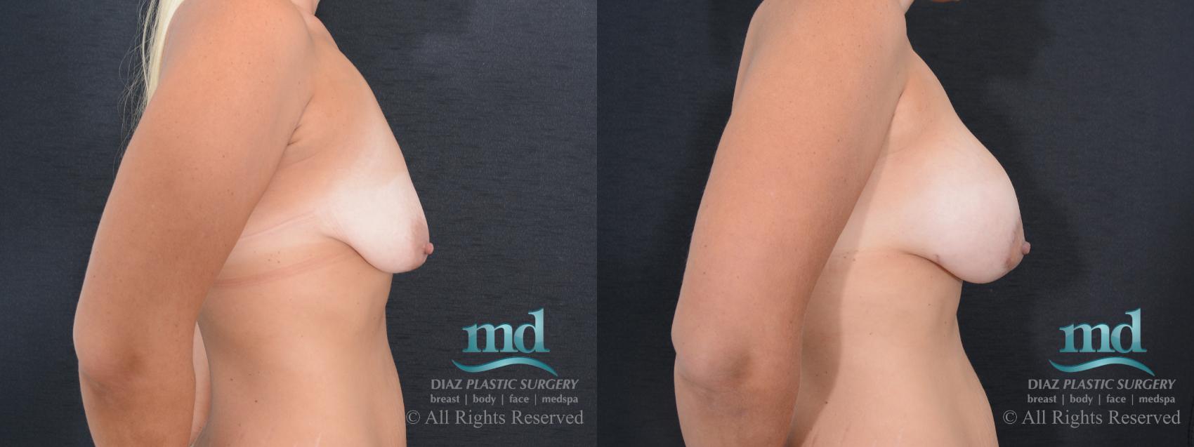 Before & After Breast Lift Case 129 View #3 View in Melbourne, FL