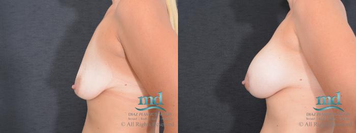 Before & After Breast Lift Case 129 View #4 View in Melbourne, FL