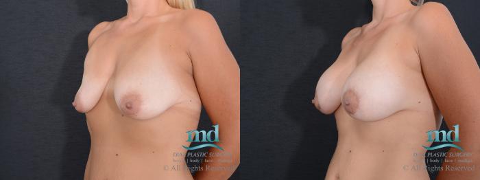 Before & After Breast Lift Case 129 View #5 View in Melbourne, FL