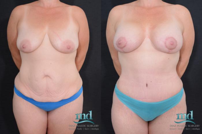 Before & After Breast Lift Case 21 View #1 View in Melbourne, FL
