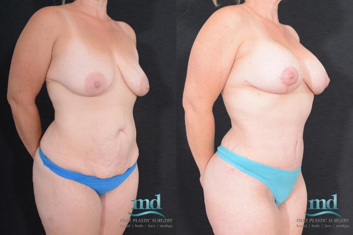 Before & After Breast Lift Case 21 View #2 View in Melbourne, FL