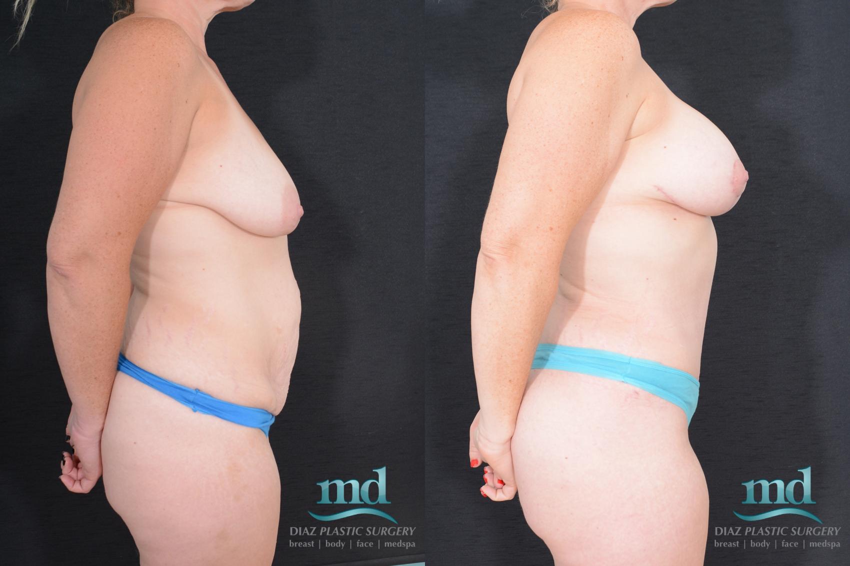 Before & After Breast Lift Case 21 View #3 View in Melbourne, FL