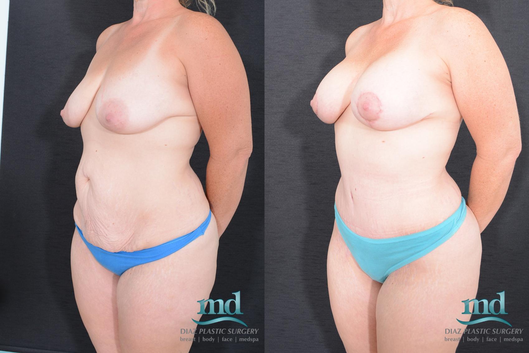 Before & After Breast Lift Case 21 View #5 View in Melbourne, FL