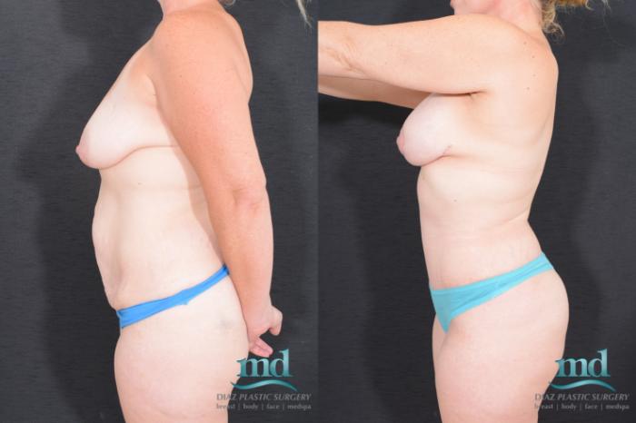 Before & After Breast Lift Case 21 View #6 View in Melbourne, FL