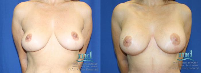 Before & After Breast Lift Case 28 View #1 View in Melbourne, FL