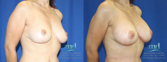 Before & After Breast Lift Case 28 View #2 View in Melbourne, FL