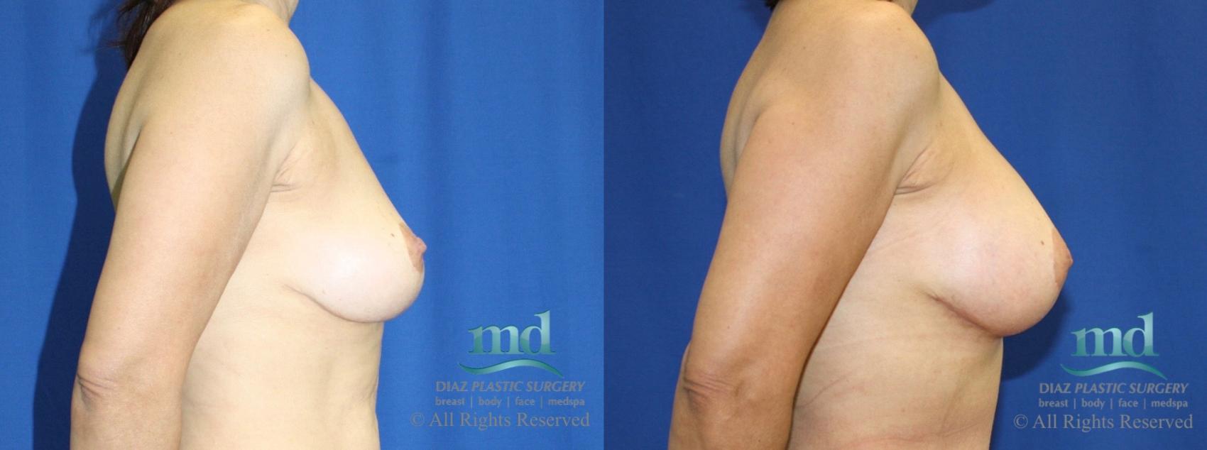 Before & After Breast Lift Case 28 View #3 View in Melbourne, FL