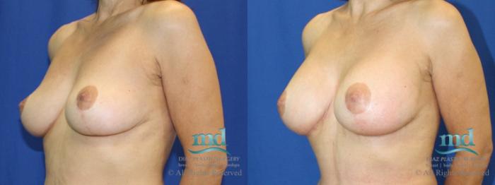 Before & After Breast Lift Case 28 View #4 View in Melbourne, FL