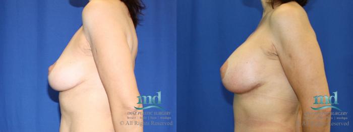 Before & After Breast Lift Case 28 View #5 View in Melbourne, FL