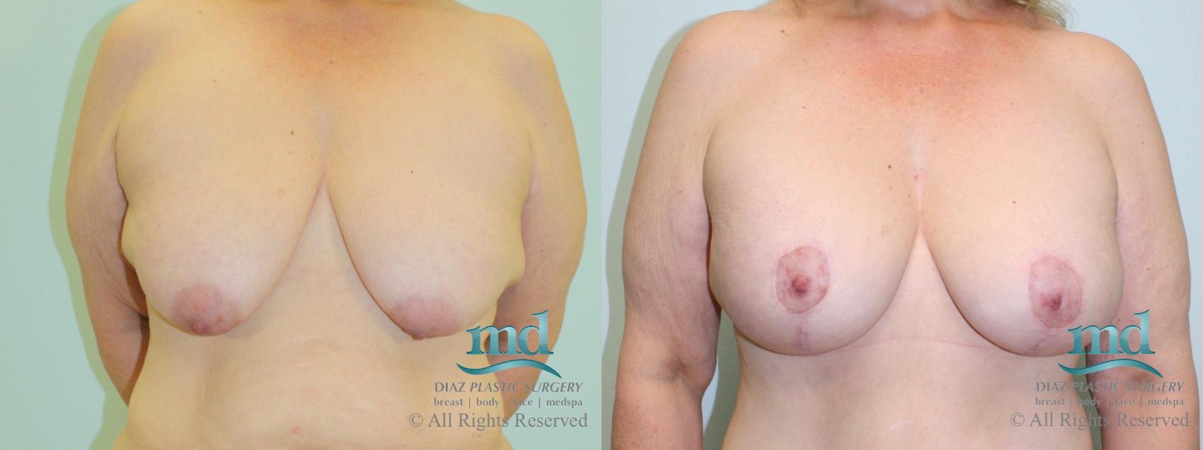 Before & After Breast Lift Case 37 View #1 View in Melbourne, FL