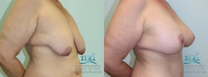 Before & After Breast Lift Case 37 View #2 View in Melbourne, FL