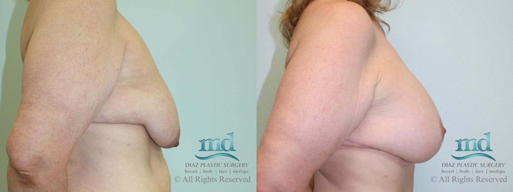 Before & After Breast Lift Case 37 View #3 View in Melbourne, FL