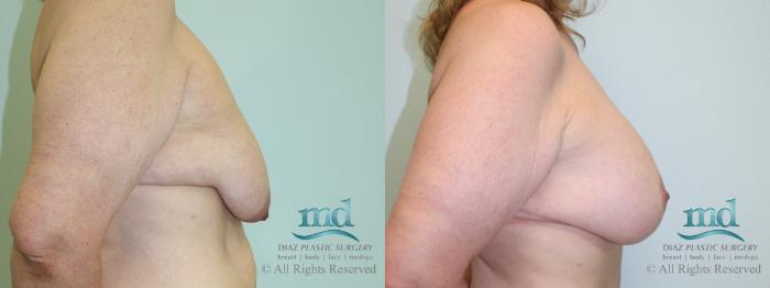 Before & After Breast Lift Case 37 View #3 View in Melbourne, FL