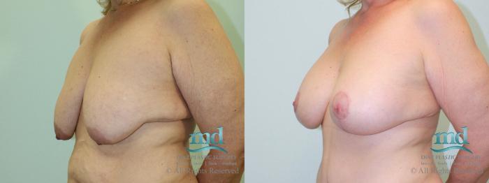 Before & After Breast Lift Case 37 View #4 View in Melbourne, FL