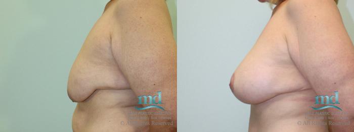 Before & After Breast Lift Case 37 View #5 View in Melbourne, FL