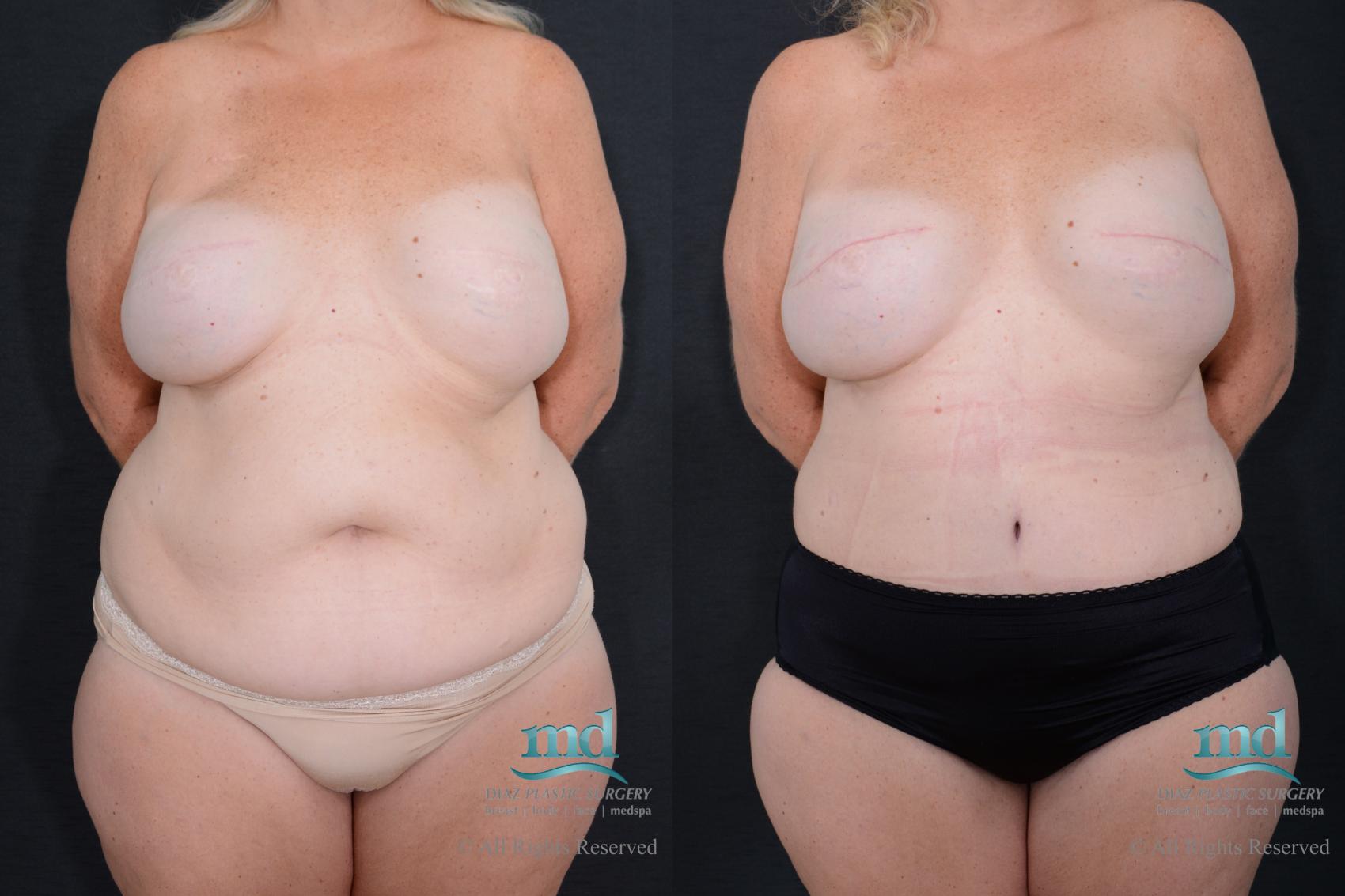 Before & After Breast Reconstruction Case 126 View #1 View in Melbourne, FL