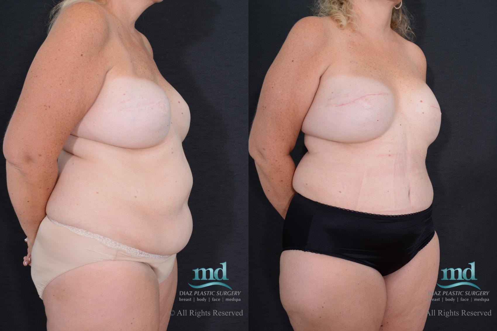 Before & After Breast Reconstruction Case 126 View #2 View in Melbourne, FL