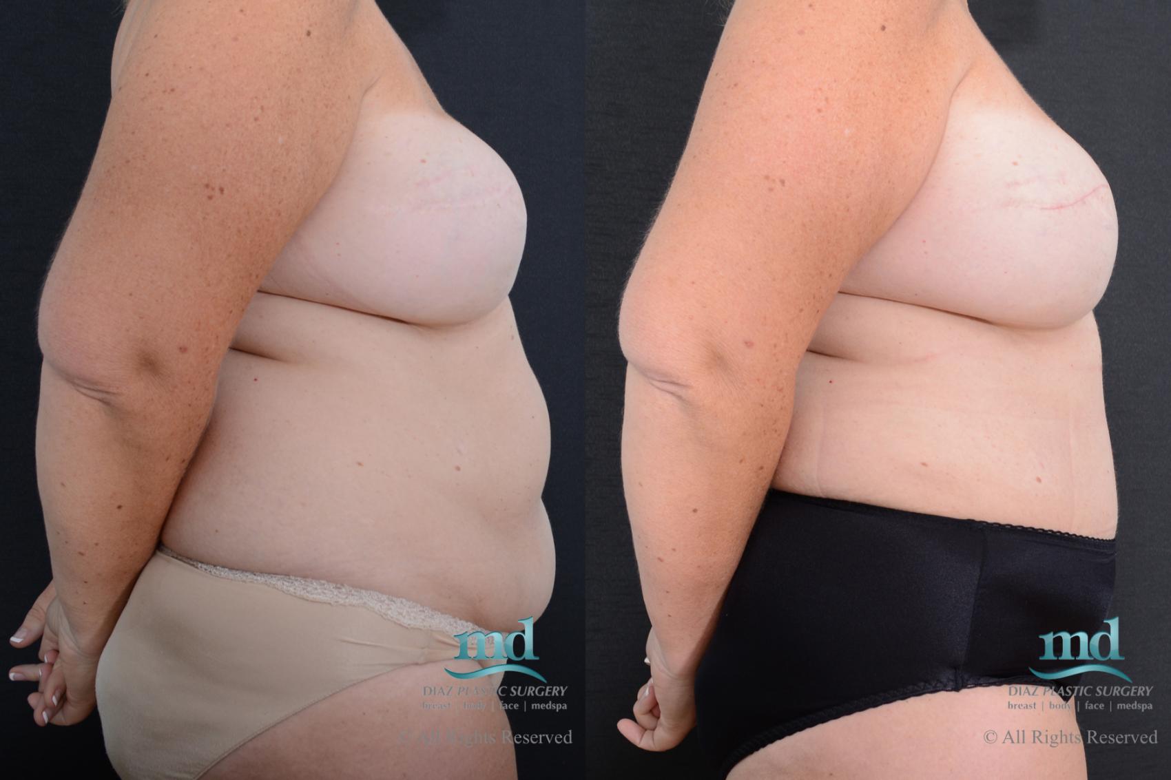 Before & After Breast Reconstruction Case 126 View #3 View in Melbourne, FL