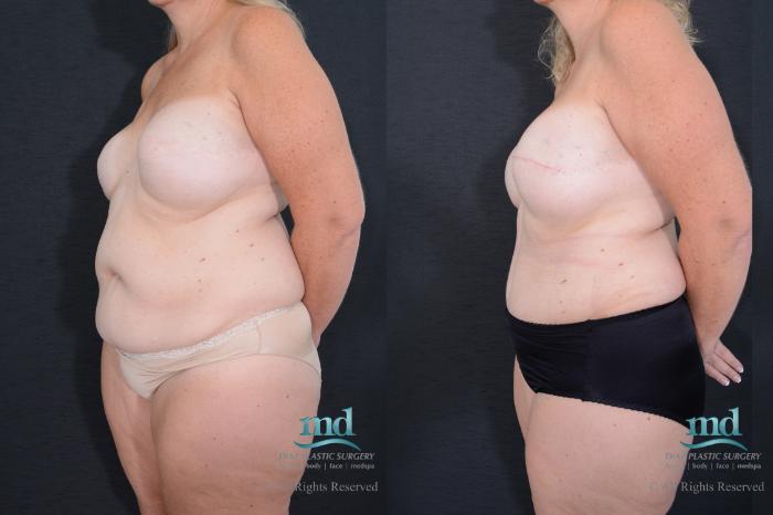 Before & After Breast Reconstruction Case 126 View #5 View in Melbourne, FL