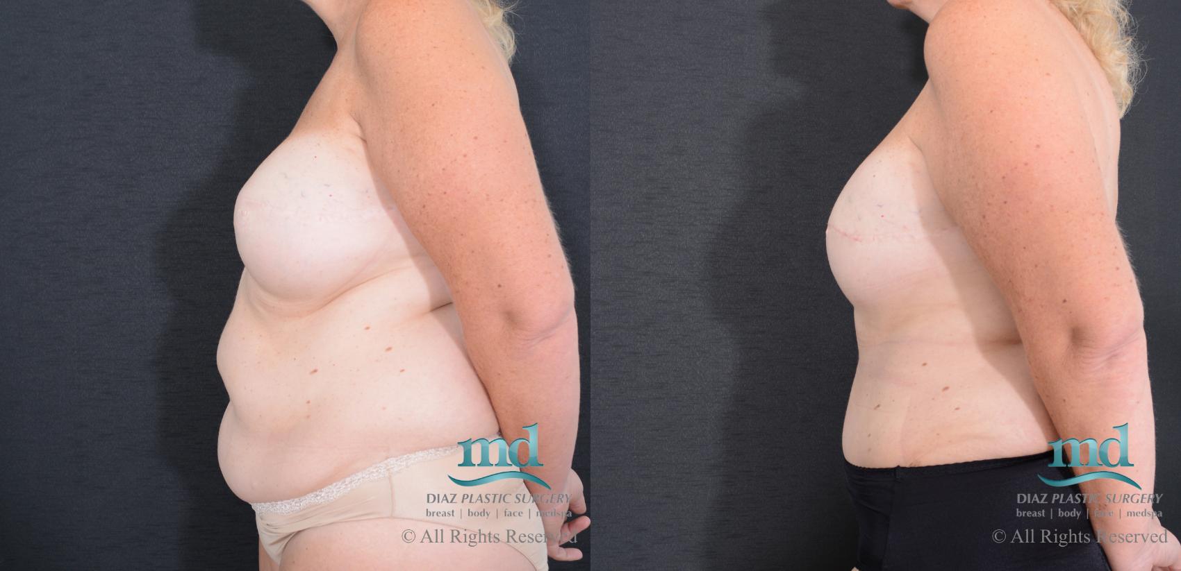 Before & After Breast Reconstruction Case 126 View #6 View in Melbourne, FL