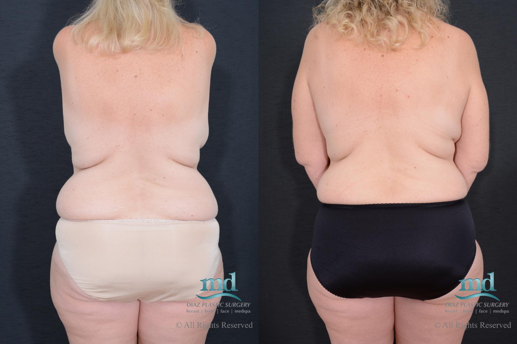 Before & After Breast Reconstruction Case 126 View #7 View in Melbourne, FL