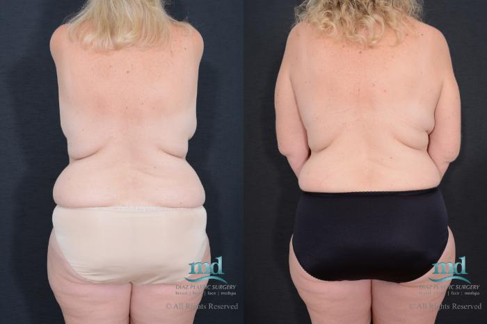 Before & After Breast Reconstruction Case 126 View #7 View in Melbourne, FL