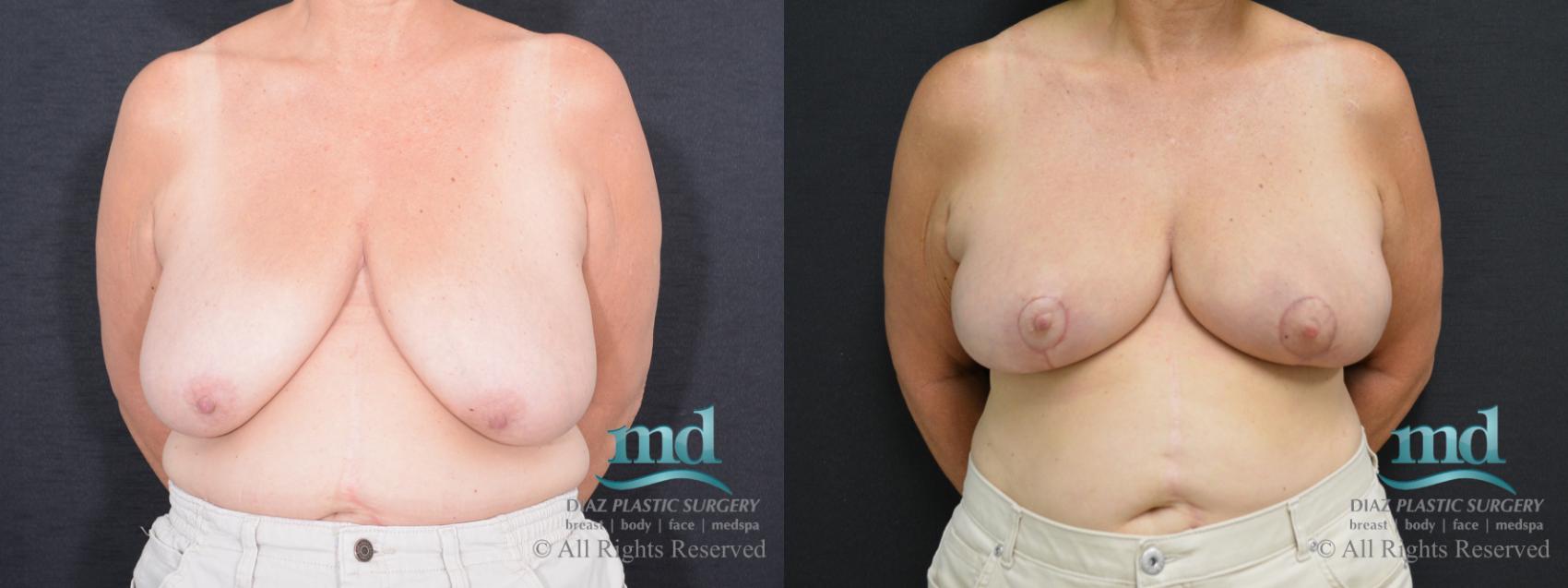 Before & After Breast Reduction Case 130 View #1 View in Melbourne, FL