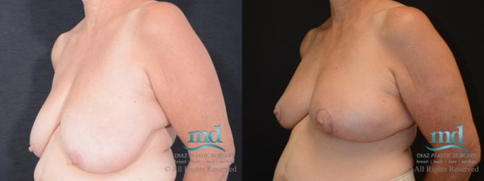 Before & After Breast Reduction Case 130 View #2 View in Melbourne, FL