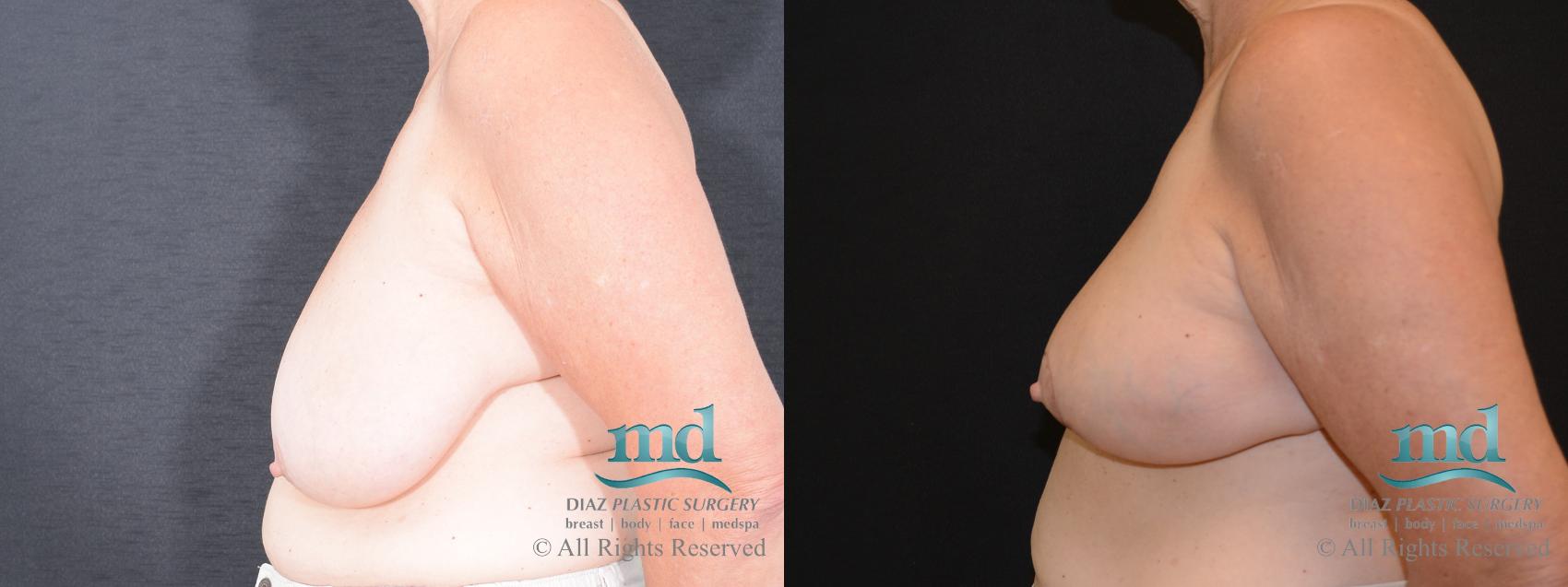 Before & After Breast Reduction Case 130 View #3 View in Melbourne, FL