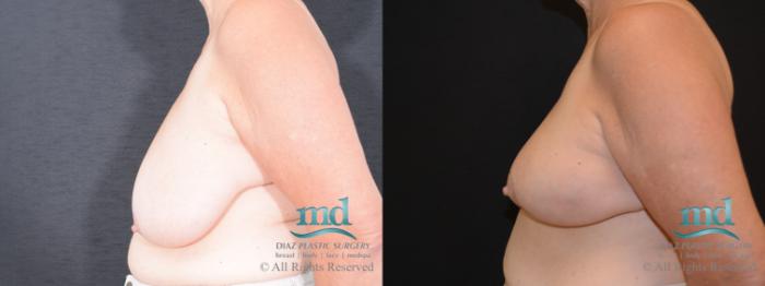 Before & After Breast Reduction Case 130 View #3 View in Melbourne, FL