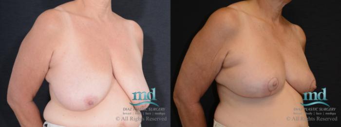 Before & After Breast Reduction Case 130 View #4 View in Melbourne, FL