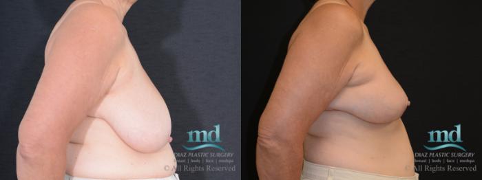 Before & After Breast Reduction Case 130 View #5 View in Melbourne, FL