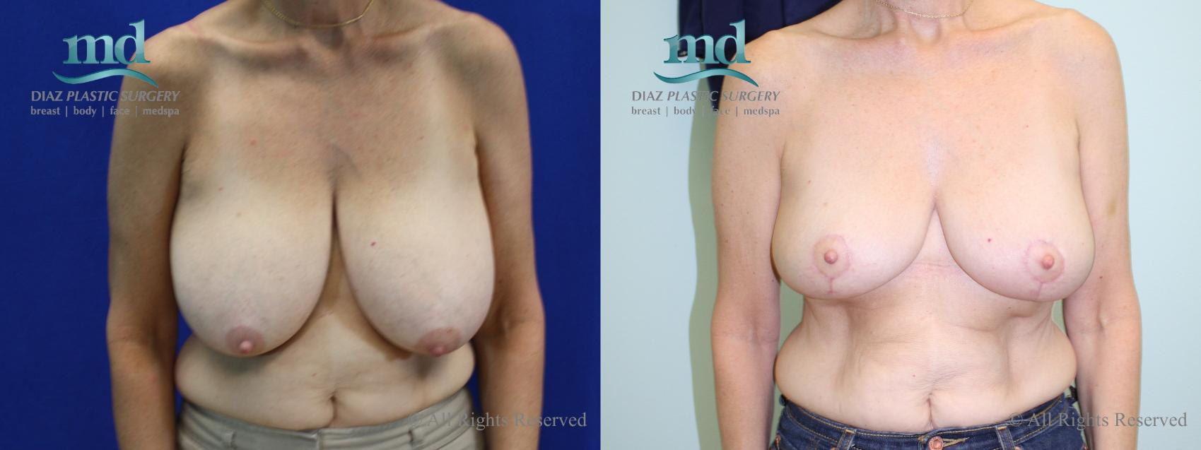 Before & After Breast Reduction Case 131 View #1 View in Melbourne, FL