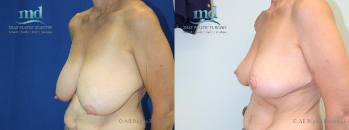 Before & After Breast Reduction Case 131 View #2 View in Melbourne, FL
