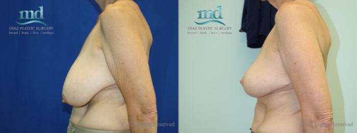 Before & After Breast Reduction Case 131 View #3 View in Melbourne, FL