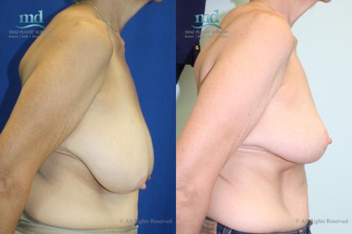 Before & After Breast Reduction Case 131 View #4 View in Melbourne, FL