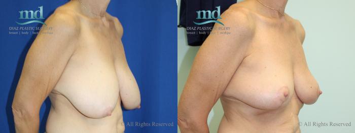 Before & After Breast Reduction Case 131 View #5 View in Melbourne, FL