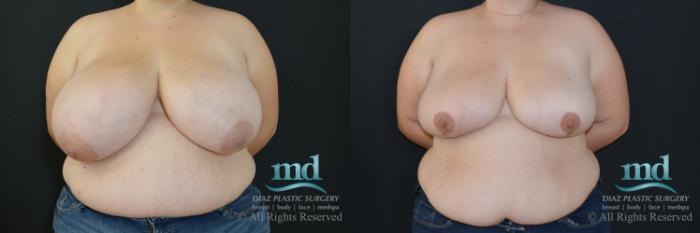 Before & After Breast Reduction Case 132 View #1 View in Melbourne, FL