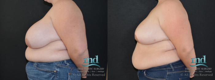 Before & After Breast Reduction Case 132 View #3 View in Melbourne, FL