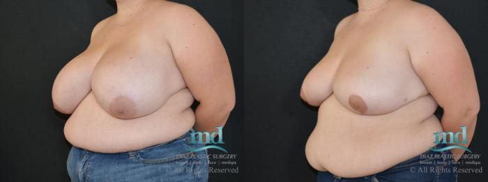 Before & After Breast Reduction Case 132 View #4 View in Melbourne, FL