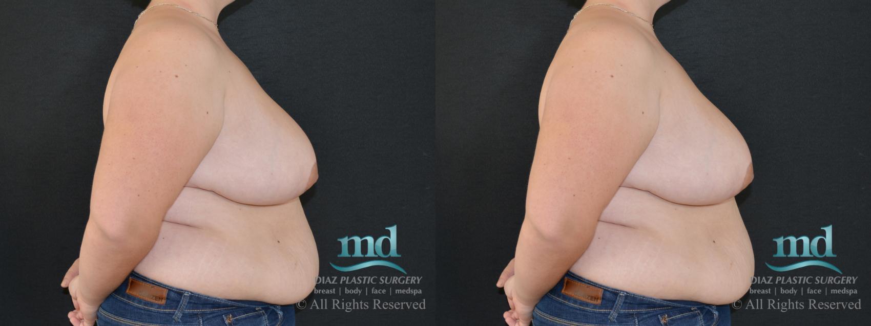 Before & After Breast Reduction Case 132 View #6 View in Melbourne, FL