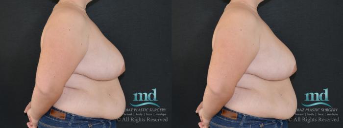 Before & After Breast Reduction Case 132 View #6 View in Melbourne, FL