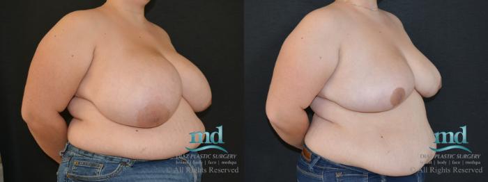 Before & After Breast Reduction Case 132 View #7 View in Melbourne, FL