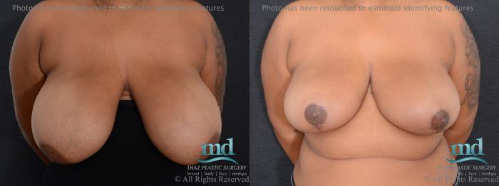 Before & After Breast Reduction Case 133 View #1 View in Melbourne, FL