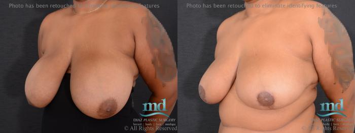 Before & After Breast Reduction Case 133 View #2 View in Melbourne, FL