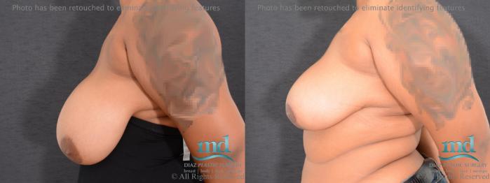 Before & After Breast Reduction Case 133 View #3 View in Melbourne, FL