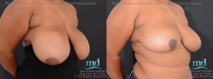 Before & After Breast Reduction Case 133 View #4 View in Melbourne, FL