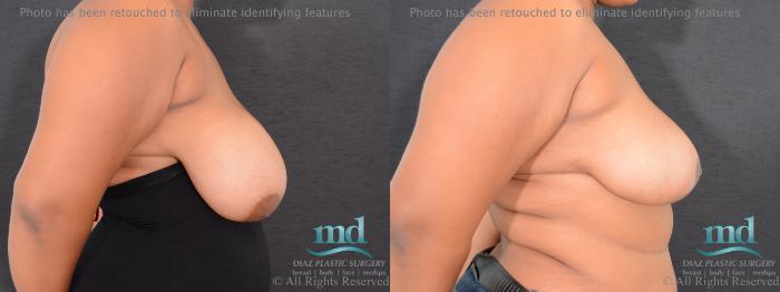 Before & After Breast Reduction Case 133 View #5 View in Melbourne, FL